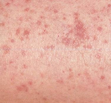 Skin Rash Identification