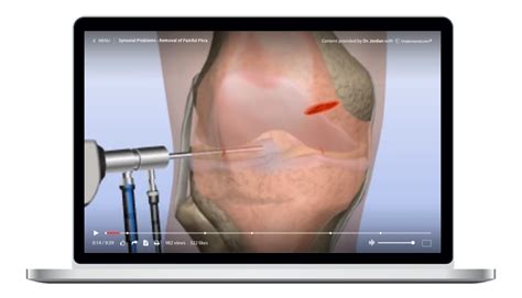 Synovial Problems - Removal of Painful Plica Animation – Understand.com