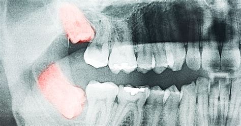 Wisdom Teeth Removal And Wisdom Tooth Extraction By Danforth Dentist