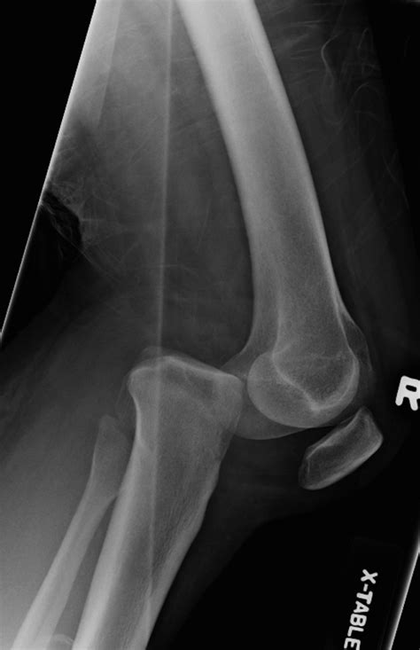 Posterior Knee Dislocation Radiology At St Vincent S University Hospital