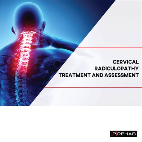 Cervical Radiculopathy Treatment And Assessment 𝗣 𝗥𝗲𝗵𝗮𝗯