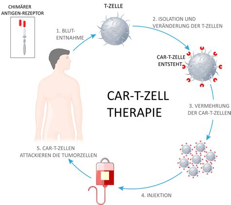 Wie läuft eine CAR T Zelltherapie ab CAR T Zell Therapie