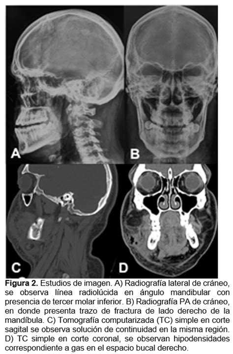 Infección como complicación de una fractura de ángulo mandibular