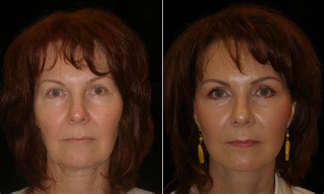 Mini Facelift On Middle Aged Female Patient Aesthetica Cosmetic Surgery And Laser Center