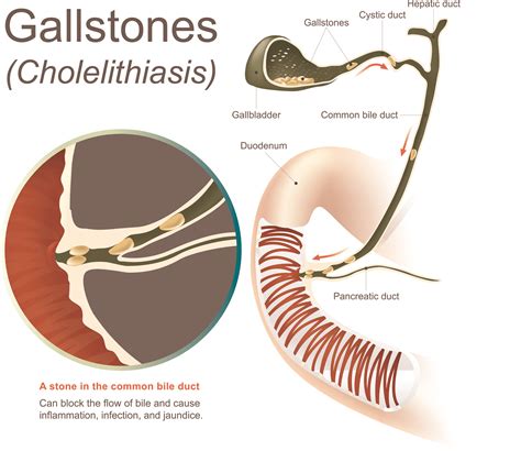 Symptoms of a Gallbladder Attack - Beaumont Emergency Hospital