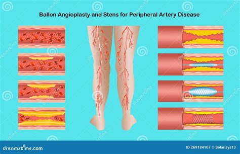 Diagram Showing Angioplasty For Peripheral Artery Disease Illustration