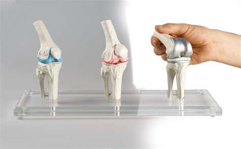 Knee Implant Model Australian Physiotherapy Equipment