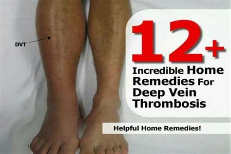 Pin By Suzanne Khorramy On Remedies Deep Vein Thrombosis Home Remedies Thrombosis