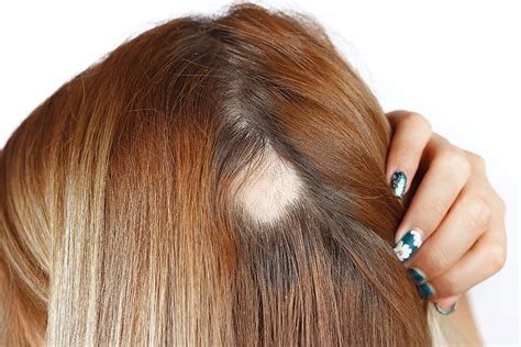 Alopecia Areata Causas S Ntomas Y Opciones Para Su Tratamiento Banner