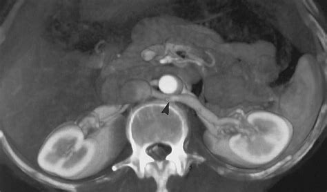 Three Dimensional Volume Rendered Ct Angiography Of The Renal Arteries