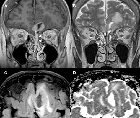 Mri Of The Anterior Skull Base Coronal T Post Contrast A And