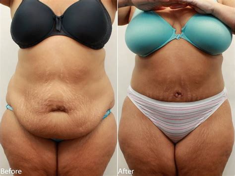 Dr Darm Tummy Tuck Before And After Pictures Tummy Tucks Tummy