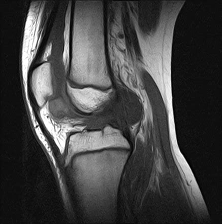 Intracapsular Chondroma Knee Image Radiopaedia Org