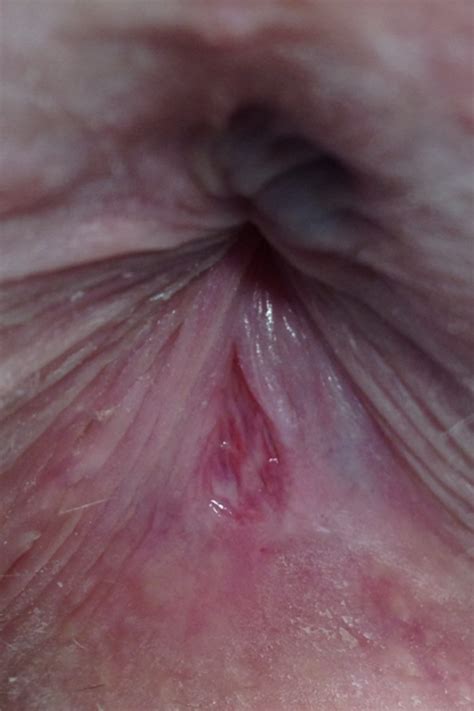 Blog do Saúde Médica Proctologia Fissura anal laser