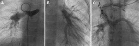 Figure 1 From Connection Of Discontinuous Pulmonary Arteries In