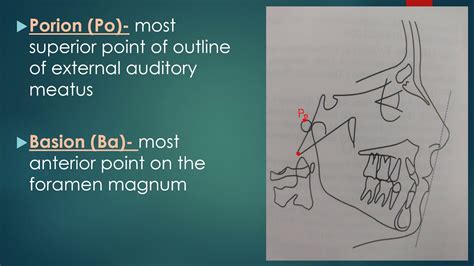 Cephalometric Landmarks Youtube