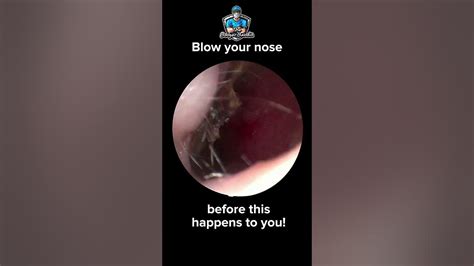 👩‍⚕️watch This Satisfying Booger Removal By Our Expert Doctor Clean