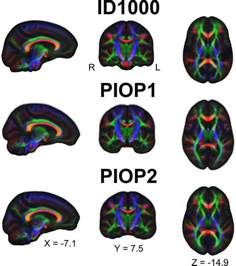 Diffusion Encoded Color Images Of The FA Modulated Median DTI