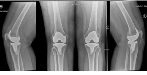 Figure From Perioperative Steroid Administration Improves Knee