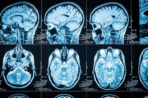 Chronic Traumatic Encephalopathy Stages