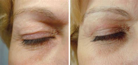 Non Surgical Eyelid Lifting Plasma Fibroblast Eyelid Treatment Skin