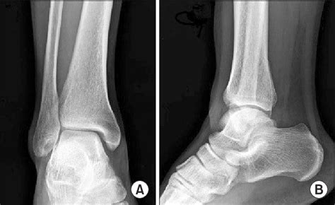 Malleolus Fracture Operative Treatment Of Posterior Malleolar Fractures Fulltext There Are