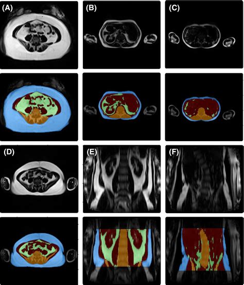 Fatsegnet A Fully Automated Deep Learning Pipeline For Adipose Tissue