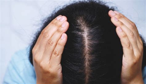 Prevenire la caduta dei capelli si può Fitopreparatori Italiani