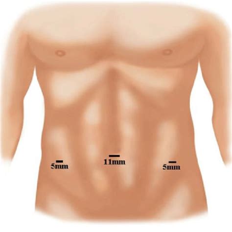 Port Placement For Tapp And Tep Hernia Repair Download Scientific Diagram