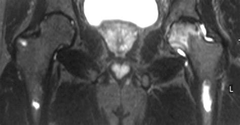 Musculoskeletal Manifestations Of Sickle Cell Disease Radiographics