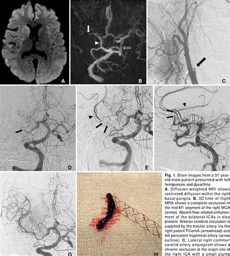 Figure 1 From Successful Cross Circulation Stent Retriever Embolectomy