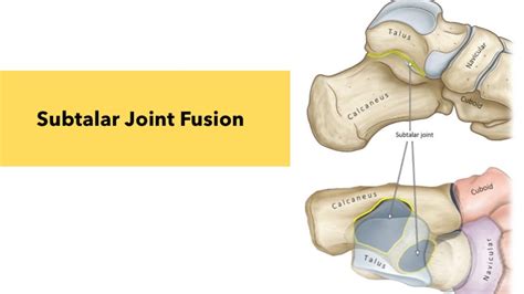 Subtalar Joint Fusion Youtube