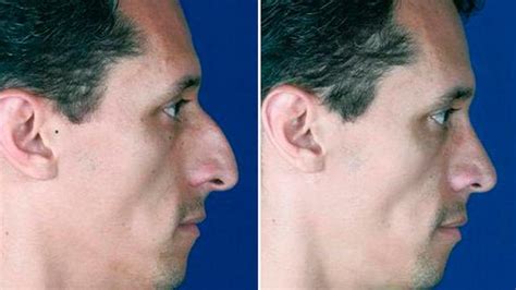 Rinoplastia En Hombres ¡métodos And Beneficios 2019