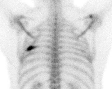 Evaluation Of Isolated Rib Lesions With Radionuclide Guided Biopsy