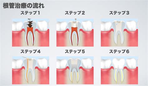 抜髄と感染根管治療について｜きたつじ歯科クリニック｜尼崎市武庫之荘駅の歯科・歯医者
