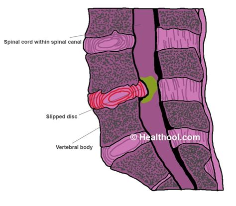 👉 Retrolisthesis Symptoms Causes Diagnosis Treatment December 2021