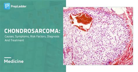 Chondrosarcoma: Causes, Symptoms, Risk Factors, Diagnosis and Treatment