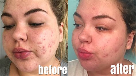 One Month Accutane Update Results Side Effects Photos Youtube