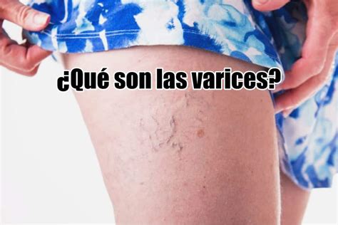 Qu Son Las Varices S Ntomas Causas Y Tratamiento