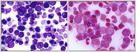 Diagnostic Approach To Myelodysplastic Syndromes And Related Neoplasms