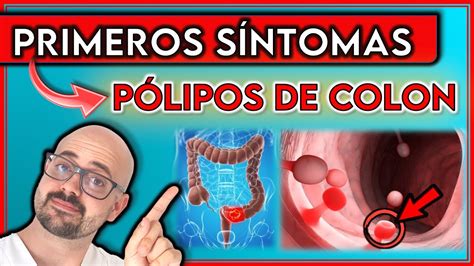 ESTOS son los 7 PRIMEROS SINTOMAS de PÓLIPOS de COLON NO los