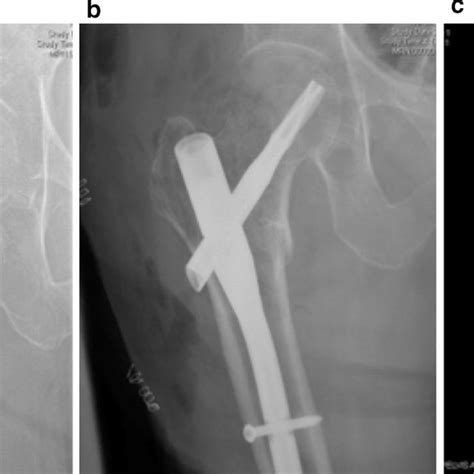 Anteroposterior Injury Radiographs Of Intertrochanteric Femur Fractures