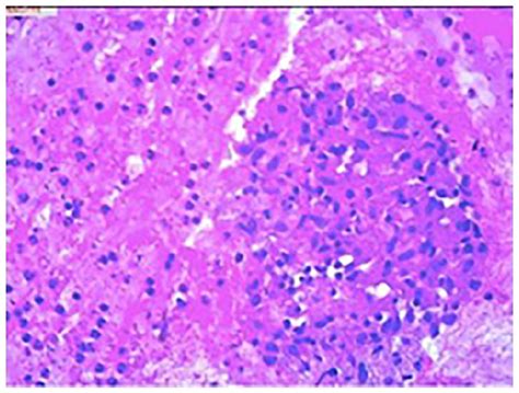 Pathology Of Enlarged Lymph Nodes Which Revealed Sarcoidosis He ×10 Download Scientific Diagram