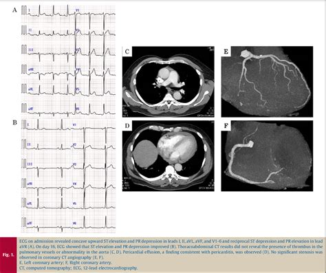 Figure 1 From Pericarditis Caused By Herpes Zoster Semantic Scholar