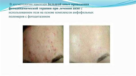 Лазерная терапия - презентация онлайн