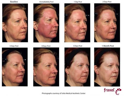 Laser Resurfacing In Philadelphia About Face Aesthetics Laser Skin