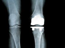 Knee Replacement X Ray Stock Photos, Images, & Pictures – (54 Images)