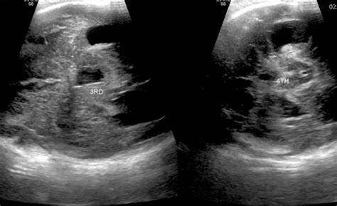 Grade Iv Germinal Matrix Hemorrhage With Periventricular Leukomalacia