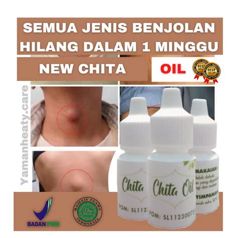 Jual Obat Oles Benjolan Original Chita Oil Atasi Keloid Atasi Uci