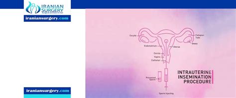 IUI Procedure Step By Step IUI Procedure Step Iranian Surgery